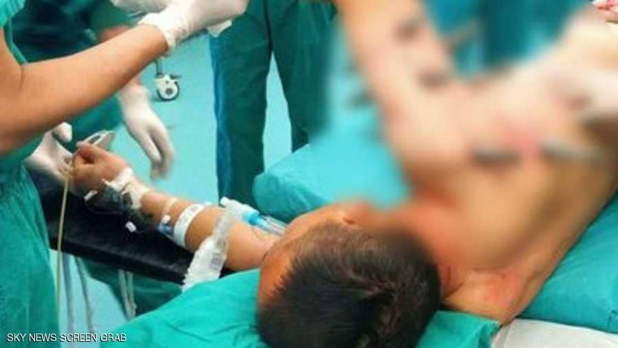 روبوت صناعي يغرز 10 قضبان معدنية في جسد عامل