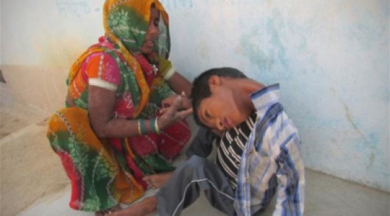 بالصور: طفل هندي يعيش برأس مقلوب للأسفل