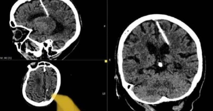 اكتشاف أبرة في دماغ عجوز روسية موجودة منذ 80 عاماً