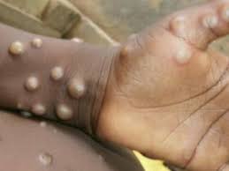  كندا رصد 100 إصابة بفيروس جدري القرود