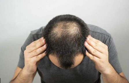 جراح مختص في زراعة الشعر يحذر الرجال من مشروبات قد تسبب الصلع