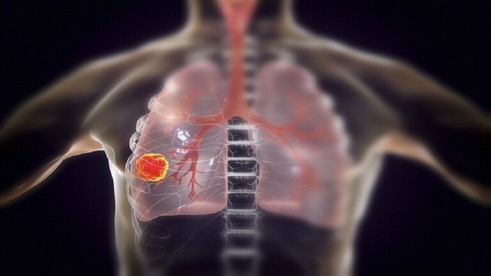 ثلاثة أدوية شائعة تمنع الإصابة بسرطان الرئة 