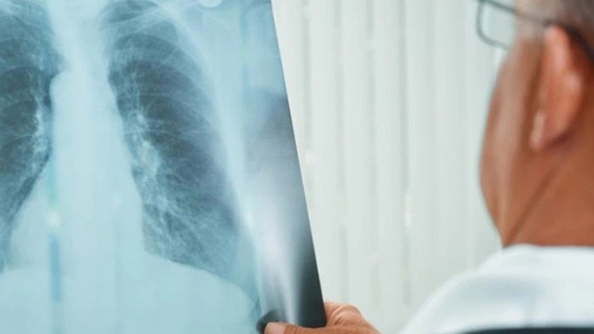 5 أطعمة تساعدك على التعافي من الالتهاب الرئوي