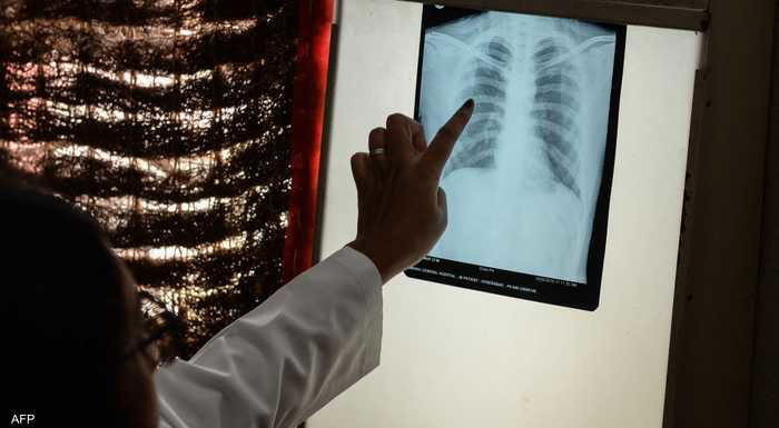 وكالة سرايا : 9 أعراض قد تكون من العلامات المبكرة لسرطان الرئة