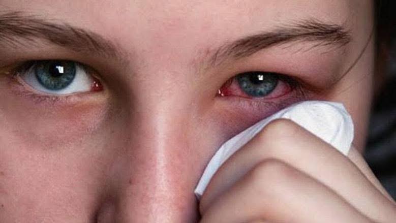 طبيب أردني يحذر من فيروس صيفي شديد العدوى يهاجم الحلق والعينين ..  وهذه أبرز أعراضه