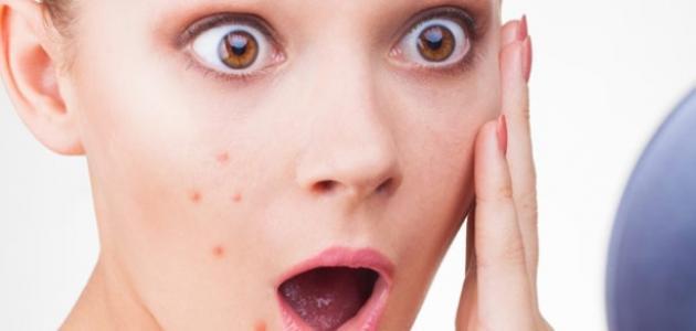 علاج الحبوب الكبيرة تحت الجلد بطرق طبيعية