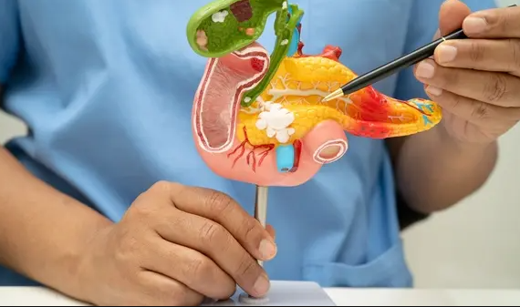 إنجاز علمي إسباني يفتح باب الأمل لعلاج سرطان البنكرياس