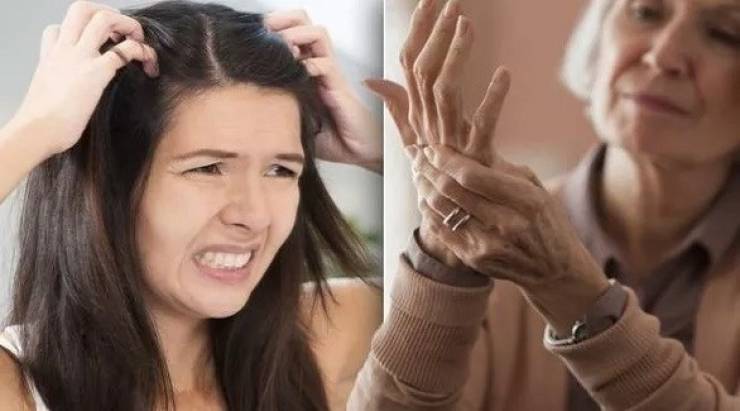قشرة الرأس قد تكون مؤشراً على هذا المرض!