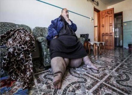 "الفيل" يجثم على أقدام فلسطيني فيحرمه الحركة  ..  "تفاصيل"
