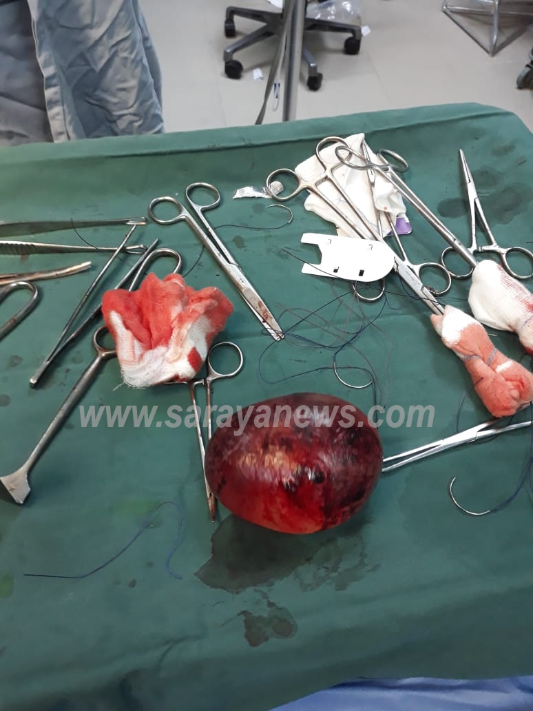 الشونه الشمالية : فريق طبي يستخرج كيس بحجم 10سم من بطن مريضه في مستشفى معاذ بن جبل