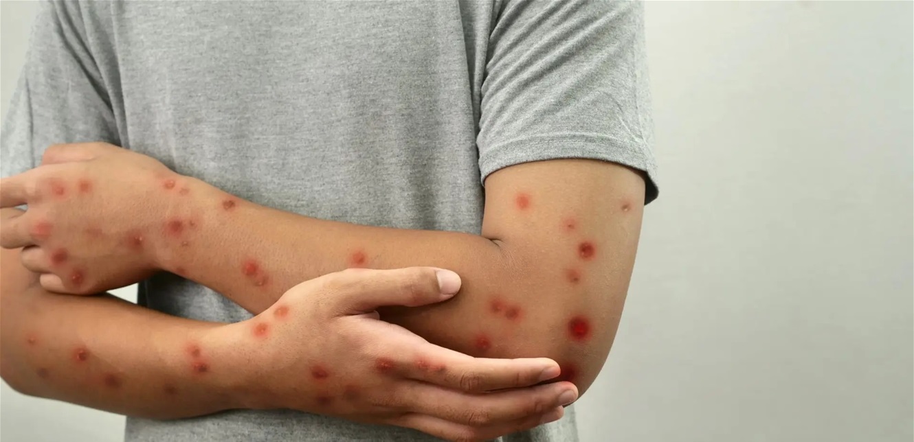 حصبة تكتسح أميركا: تسجيل نحو 900 حالة والإصابات تتزايد