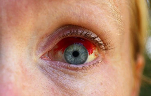 تفسير حلم خروج الدم من العين  