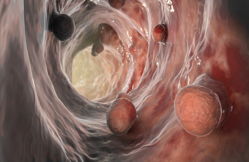 مشروبات شائعة الاستهلاك تضاعف خطر الإصابة بسرطان الأمعاء