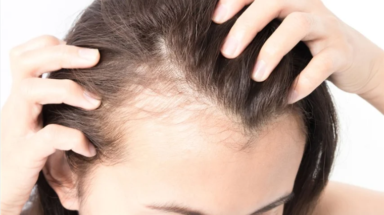 تساقط الشعر عند النساء ..  أطباء يوضحون الأسباب والحلول