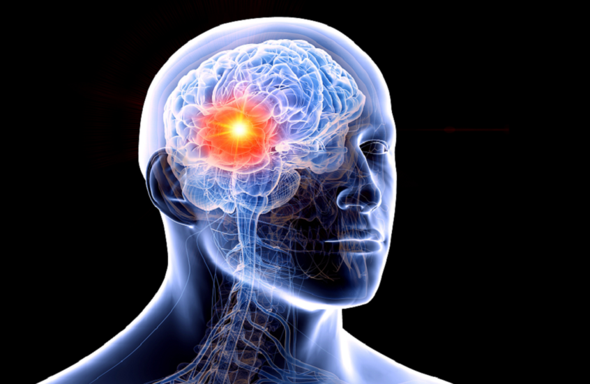 اكتشاف سبب غير متوقع يزيد خطر الإصابة بأورام الدماغ