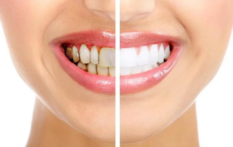 إليك 3 حيل سحرية تقضي على اصفرار الأسنان نهائياً