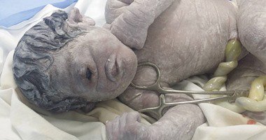 ولادة طفل بـ"عين واحدة" في مصر "صورة"