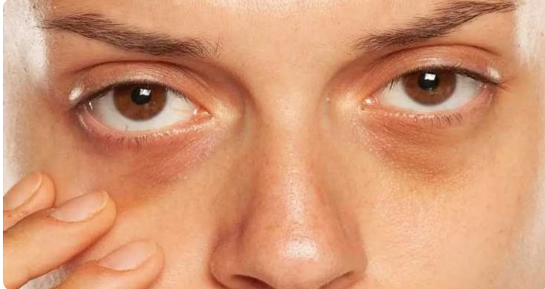 لكل منها دلالة  ..  ماذا تعني ألوان الهالات تحت العينين ؟