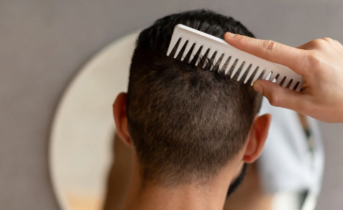 10 وصفات منزلية فعالة جداً في محاربة قشرة الشعر
