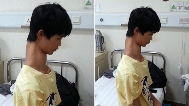 بالصور| مراهق صيني يخضع لعملية جراحية لتقصير عنقه
