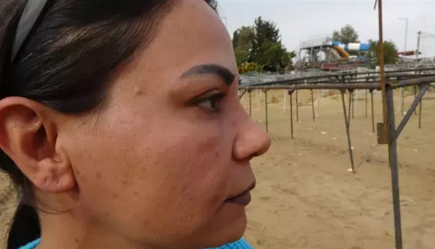 عملية تجميل فاشلة تحول حياة أربعينية إلى كابوس في تركيا