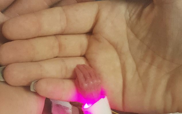 بالصور  ..  مولودة تتحدى توقعات الأطباء بوفاتها في الحال