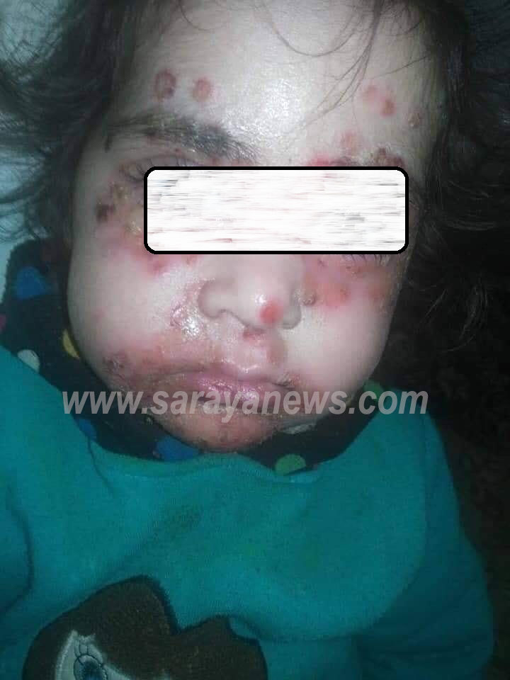 طفلة بعمر الورد حرمت من الابتسامة والفرح تناشد الأردنيين   ..  "تفاصيل"