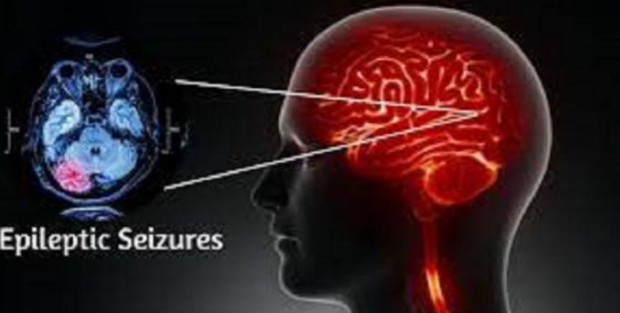 علاج غير جراحي يمنح الأمل في السيطرة الدقيقة على نوبات الصرع