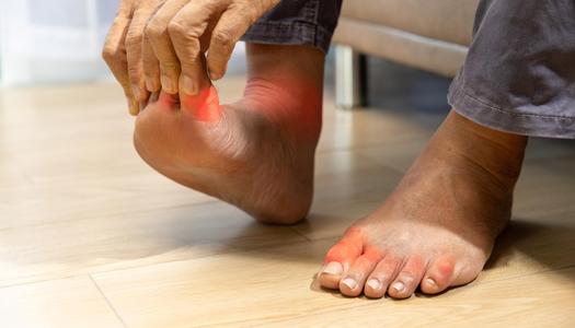 ما هو النقرس  ..  اكتشف أعراضه وأسبابه وكيف تتجنّبه