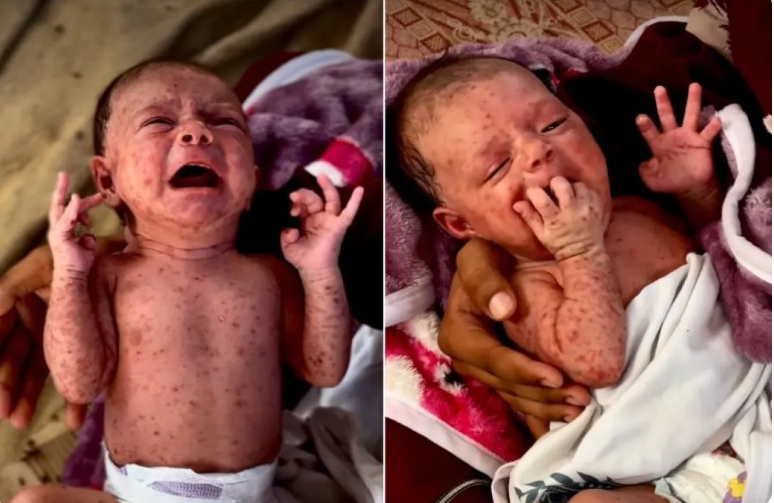 جدري الماء ينهش أجساد أطفال غزة