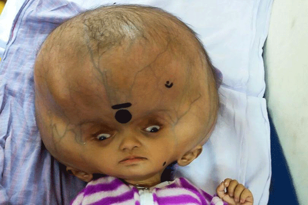 بالصور ..  هل تذكرون الطفل صاحب أكبر رأس في العالم ..  إليكم ما حدث له!