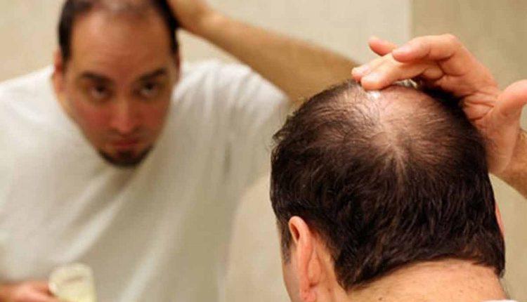 فوائد الثوم لعلاج الصلع ومشكلات فروة الرأس