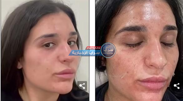 بالصور  ..  علاج غريب في عالم التجميل  ..  تقشير البشرة مثل الأفعى يساهم في علاج العديد من المشاكل 
