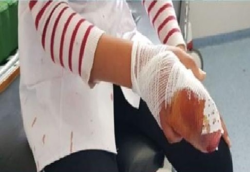 بسبب خلاف خارج مدرسة اعدادية  ..  طالبة تبتر أصابع زميلتها بالسلاح الأبيض داخل الفصل  ..  "تفاصيل"