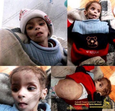 بالفيديو .. طفلة فلسطينية تصارع الموت من الجوع ووالدتها تصرخ وتناشد