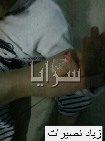 غياب الرقابة في حضانة تتسبب ببتر أصبع طفل أردني  ..  صور مؤلمة  