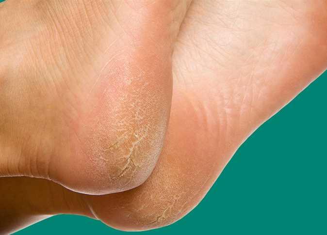 علاجات طبيعية من مطبخك للقضاء على تشقق القدمين