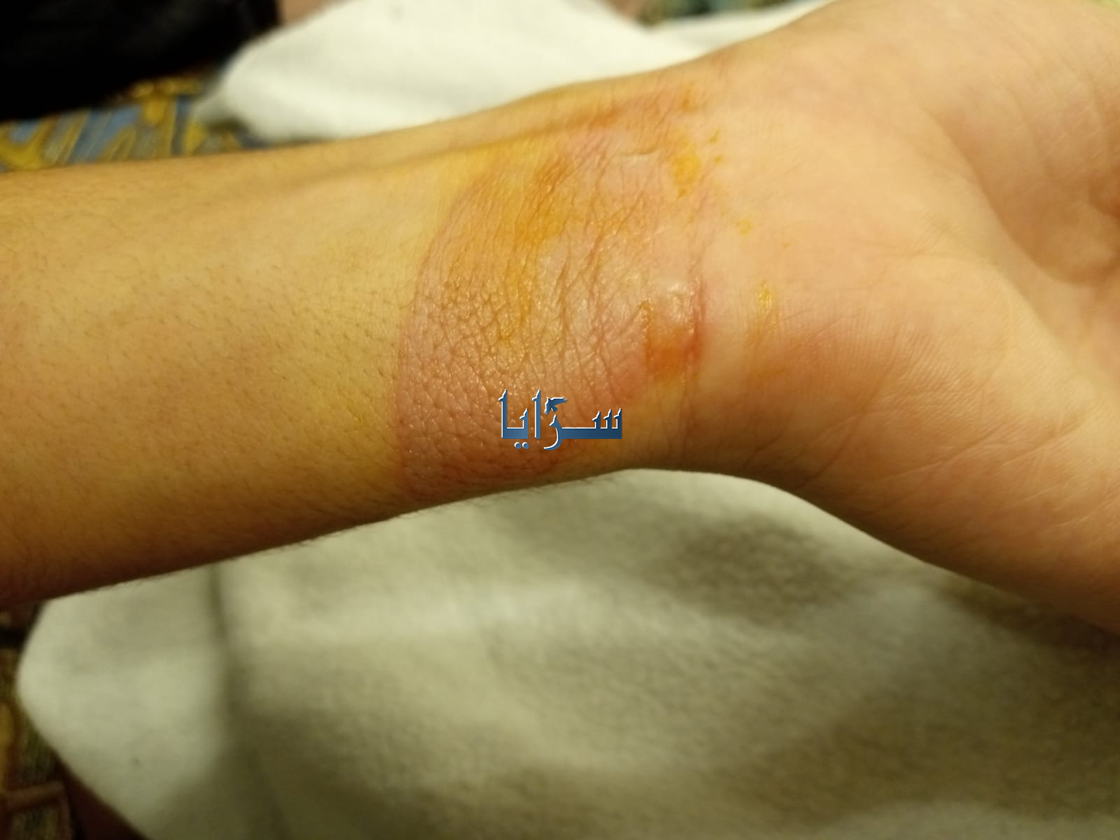 طالب يحرق "يد" زميله في مدرسة بإربد وعائلة الطفل لسرايا:" المدرسة لم تتخذ اجراء"  - صور