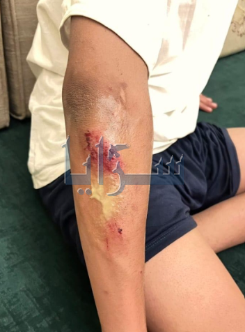 4 كلاب ضالة تهاجم طفلاً في المفرق (صور)