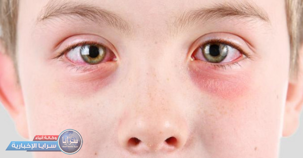 ما أسباب العين الوردية التي تصيب الأشخاص؟