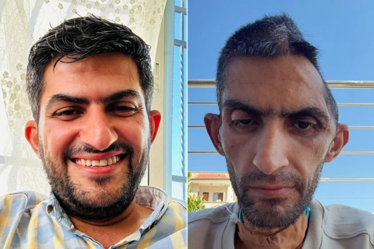 جمجمته تروي العذاب ..  صورة صادمة لمجاهد بني مفلح بعد خروجه من سجون الاحتلال