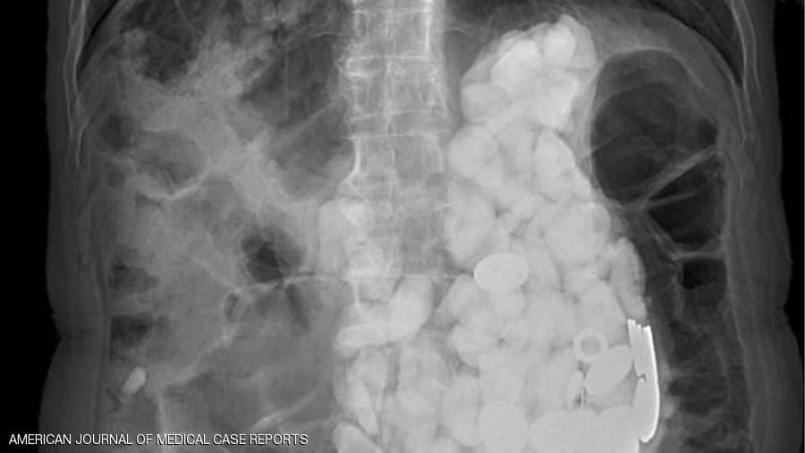 رجل يصدم الأطباء بمقتنيات غريبة في معدته