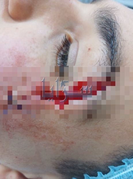 صور صادمة  ..  الاعتداء على طالبين وضربهما بـ"مشرط" أمام مدرستهما في إربد 