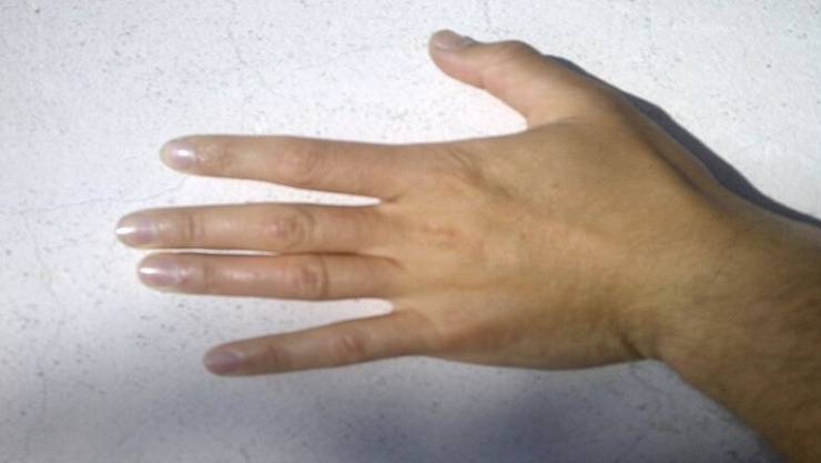 ما سبب الآلام في مفاصل الأصابع ومشط اليد؟ هل هي ناتجة عن التهاب أم سببها فيروسات؟