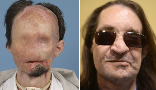 تفاؤل بمستقبل عمليات زرع الوجه بعد شفاء أول مريض أجراها