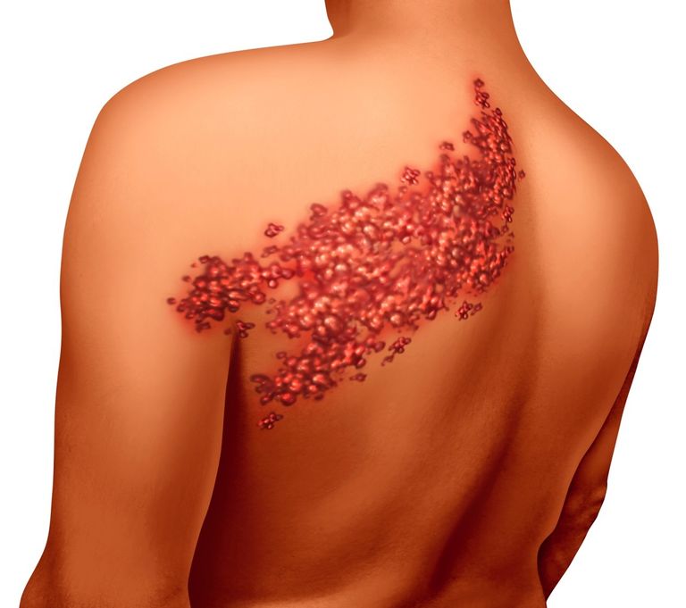 طرق علاج الحزام الناري منزلياً وبالأدوية