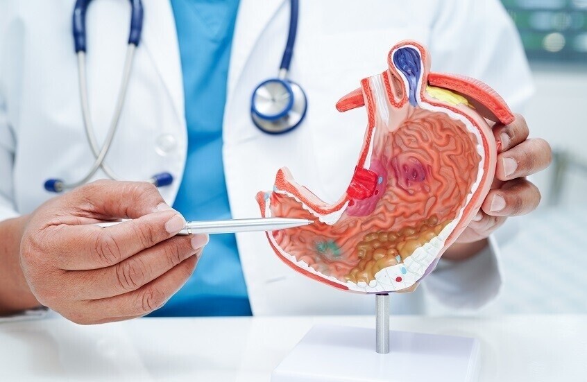 علماء روس يبتكرون طريقة لعلاج قرحة المعدة باستخدام صفيحات قلب العجل