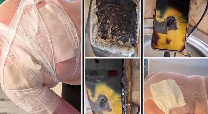 إصابة شاب أيرلندي بحروق بالغة إثر اشتعال هاتفه أثناء الشحن ليلا
