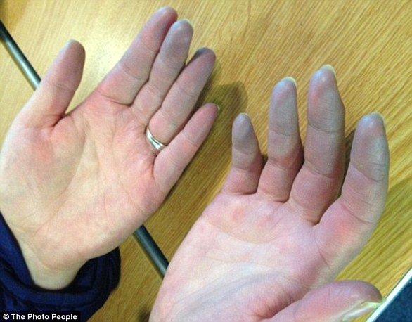 بالصور .. مذيعة شهيرة تصاب بمرض نادر في إصبع يدها