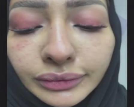بالفيديو  :تعرف على قصة ريم ضحية إبر الفيلر  وماذا حصل لها 